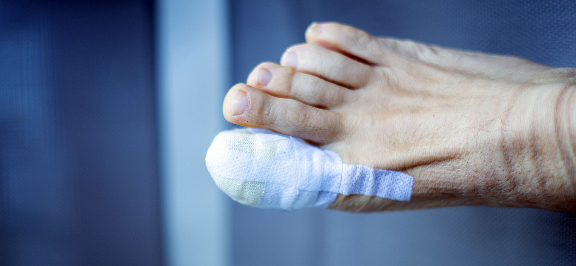 Diabetic Wound Care - Toe Strapped for diabetic ulcers treated by Manuka Honey
